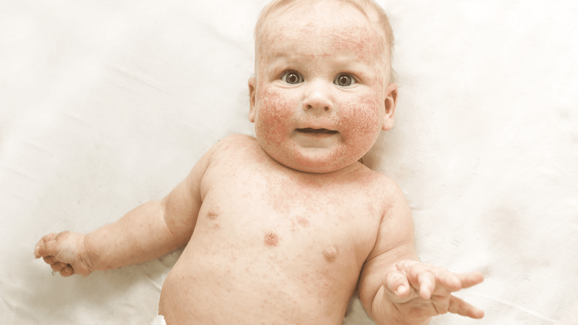 COLIC REFLUX INFANT ALLERGIES COURSE ACCENT IMAGE
